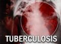 Benue government raises alarm over Tuberculosis infection