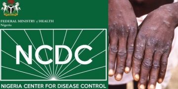 NCDC Confirms 21 Cases of Monkeypox