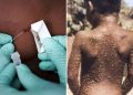 Adamawa Announces Monkeypox Outbreak