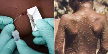 Adamawa Announces Monkeypox Outbreak