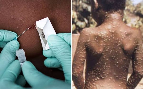 Adamawa Announces Monkeypox Outbreak