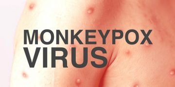 Kwara Confirms First Case of Monkey pox