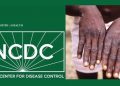 NCDC Warns that Monkey Pox is Sexually Transmitted