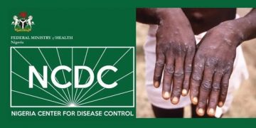 NCDC Warns that Monkey Pox is Sexually Transmitted