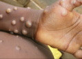 FG partners WHO to curb monkey pox spread