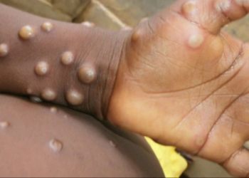 FG partners WHO to curb monkey pox spread