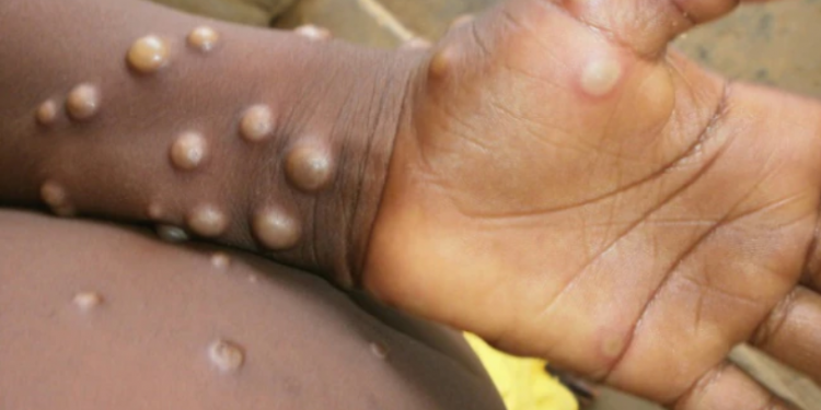 FG partners WHO to curb monkey pox spread