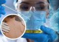India Confirms First Case of Monkey pox
