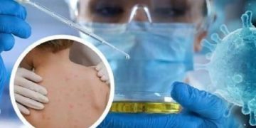India Confirms First Case of Monkey pox
