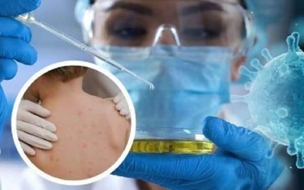 India Confirms First Case of Monkey pox