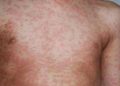 Measles Outbreak in Rivers Claim Lives