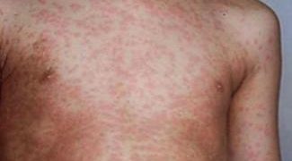 Measles Outbreak in Rivers Claim Lives