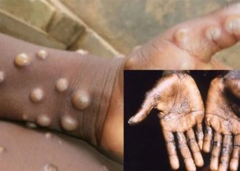 NCDC Confirms New Cases of Monkey Pox