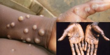 NCDC Confirms New Cases of Monkey Pox
