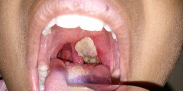 Kano Government Confirms Outbreak of Diphtheria disease